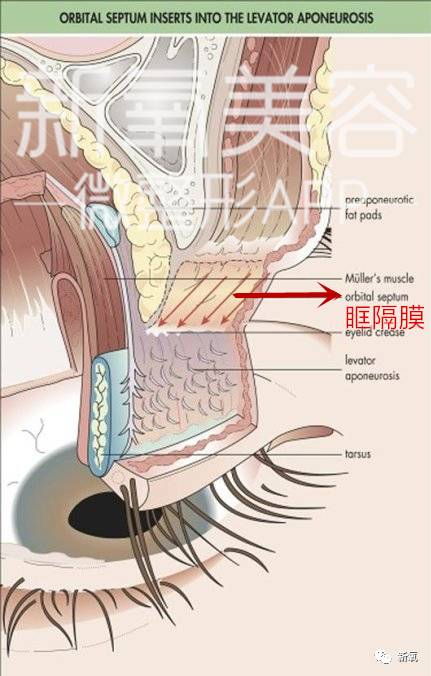 还记得有个叫眶隔膜的东西不,它的存在就是用来收紧包裹住眼底的脂肪.