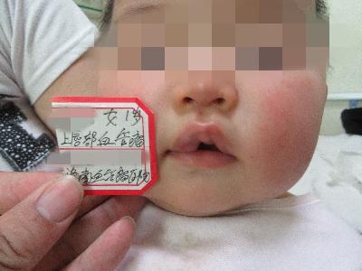 婴幼儿时期的血管瘤可以长大了再治疗吗?血管瘤不治疗会怎么样?