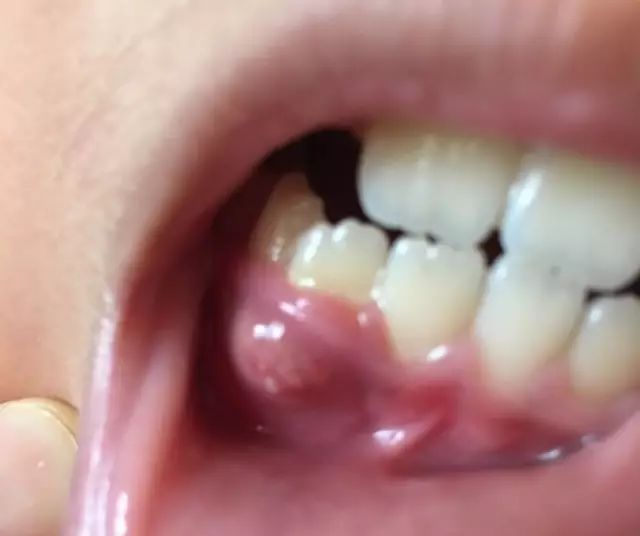 起脓包后又该怎么治疗呢?怎么预防孩子的牙龈起脓包呢?