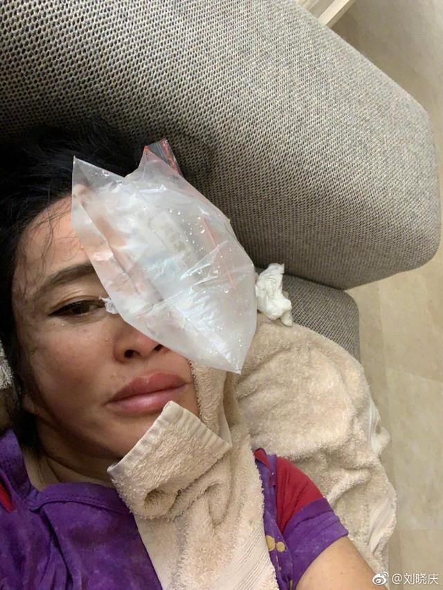 刘晓庆误撞玻璃门满脸瘀青，晒照强调自己“没整容”
