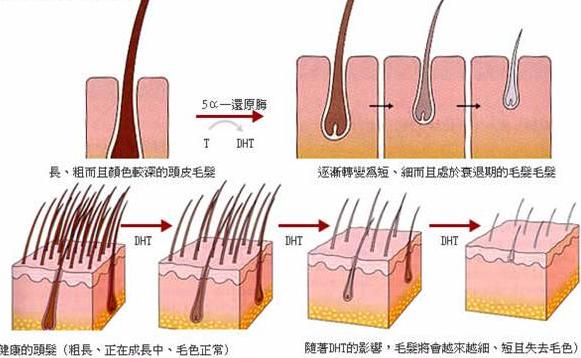脱发与头皮变硬有什么关系呢?