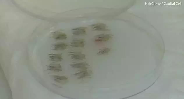 外国人治疗脱发的姿势，越来越骚了……
