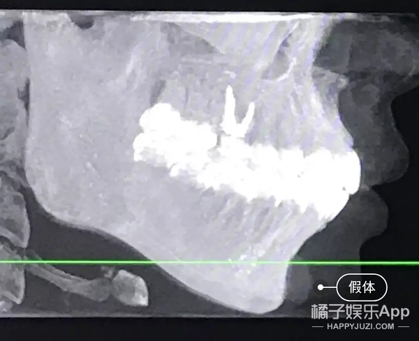 她这下巴是不是整失败了？