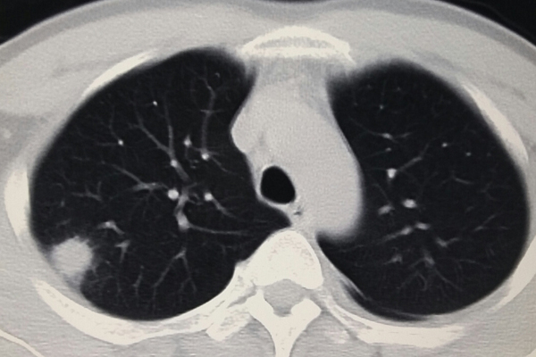体检查出肺部结节,怎么判断肺里的小结节是不是肺癌?