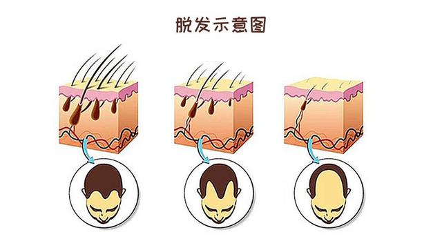 植发6个月与9个月有什么差别?植发手术的特点有哪些?