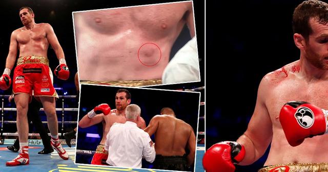 重量级拳坛再现泰森式咬人丑闻,中国拳击冠军:应该重罚!