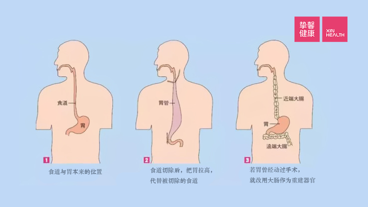 重建器官示意图