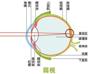 儿童常见的“四类”眼疾,容易致视力模糊