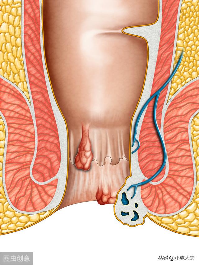 啥是内痔,啥是外痔?痔疮常见的4种临床表现,医生都告诉你