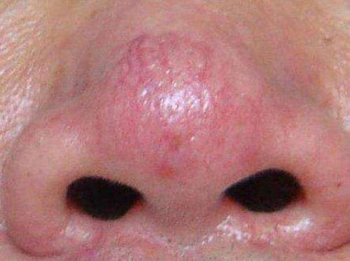 鼻子角质层薄怎么办 五个方法有效改善红鼻子