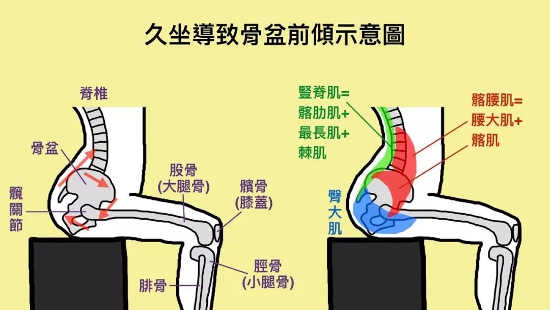 竖脊肌长期缩短紧绷, 把骨盆下侧往上拉, 导致骨盆前倾, 这样的后果从