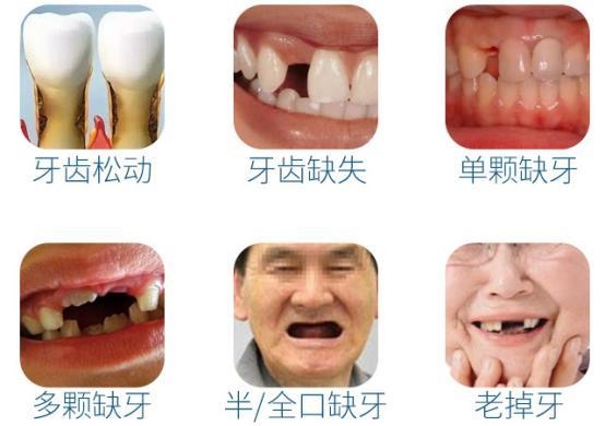 杭州种一颗牙需要多少钱?听听26岁女患者怎么