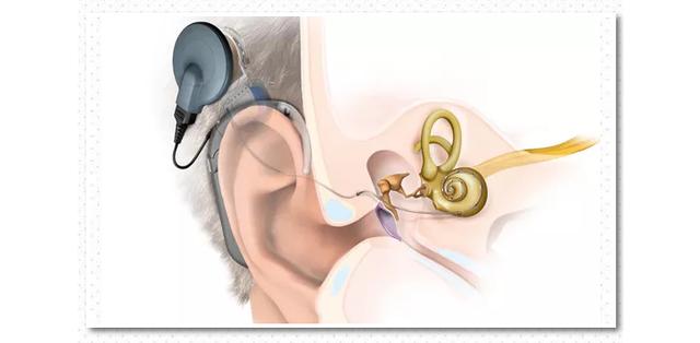 什么样的听力情况需要做人工耳蜗