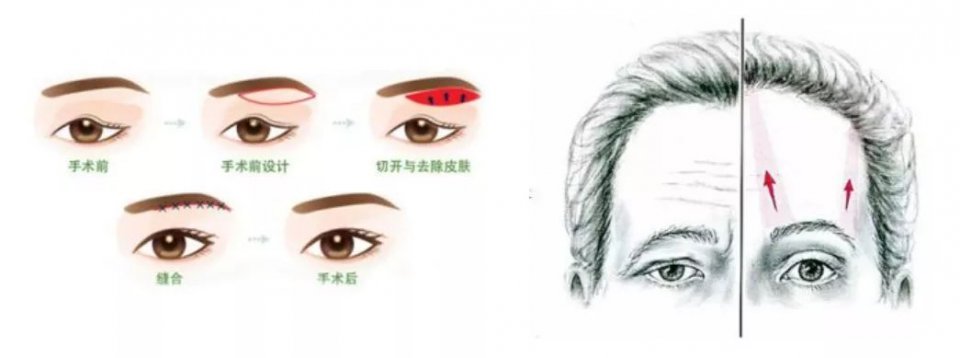赵薇拉皮把眼睛拉飞了？！