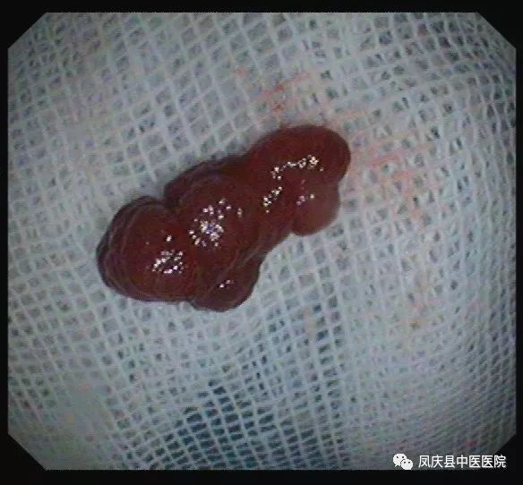 凤庆县中医医院脾胃病科成功开展首例内镜下结肠息肉切除术