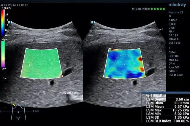 剪切波弹性成像:于细微处见真知