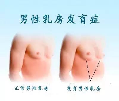 成都三代试管价格（医生有你：怎么判断自己是不是男乳肥大？）