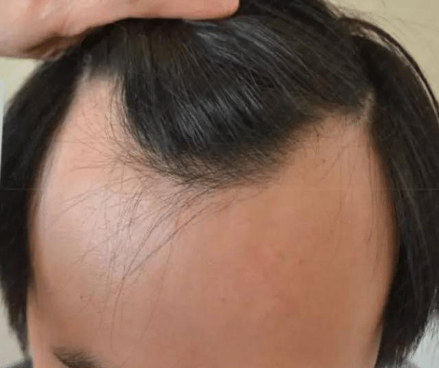 脱发来临前，头上出现的4个信号，别视而不见，要趁早注意
