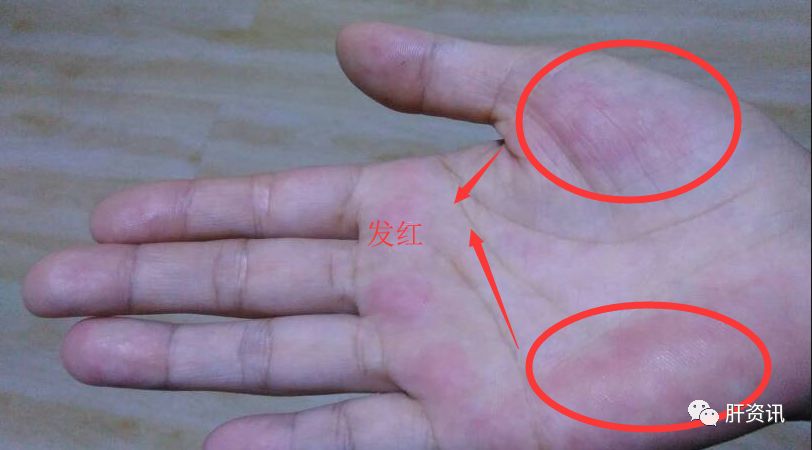 除了蜘蛛痣,还有一种红—肝掌,病因和蜘蛛痣一样,不过它主要是手掌