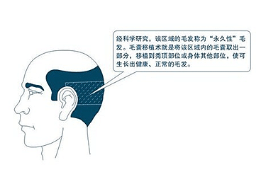 头发毛囊受损还能长出头发吗?北京毛囊移植有用吗?
