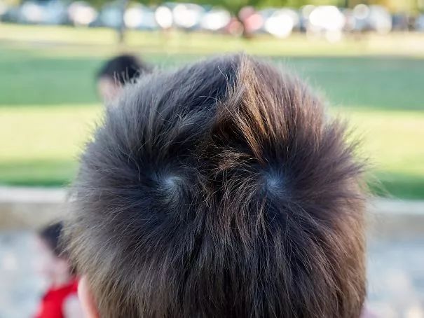 头顶具有"双旋"看起来挺酷,但是可能给理发师造成困扰有的人多一个