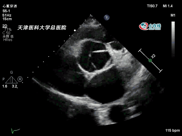 二维胸骨旁心底短轴切面显示撕裂的内膜片累及主动脉瓣右冠瓣和无
