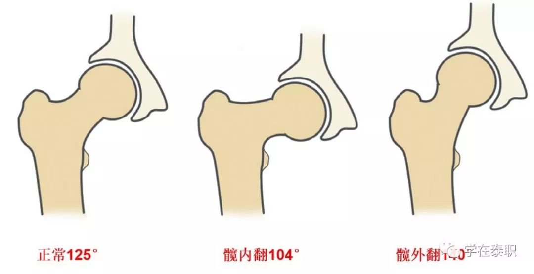 股骨的颈干角125° 成角:股骨头长轴和股骨干长轴的夹角.