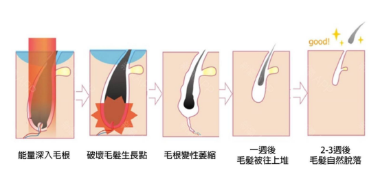 激光脱毛一次讲完 & 常见问题解答