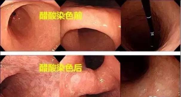 “肠上皮化生”,到底是一种什么病?真的会癌变吗?