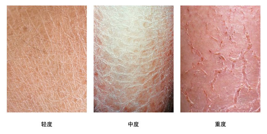 乏脂性湿疹,俗称干性湿疹或者皮肤干燥性皮炎.