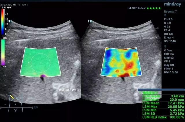 剪切波弹性成像:于细微处见真知