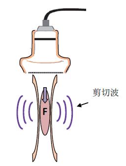 剪切波弹性成像:于细微处见真知