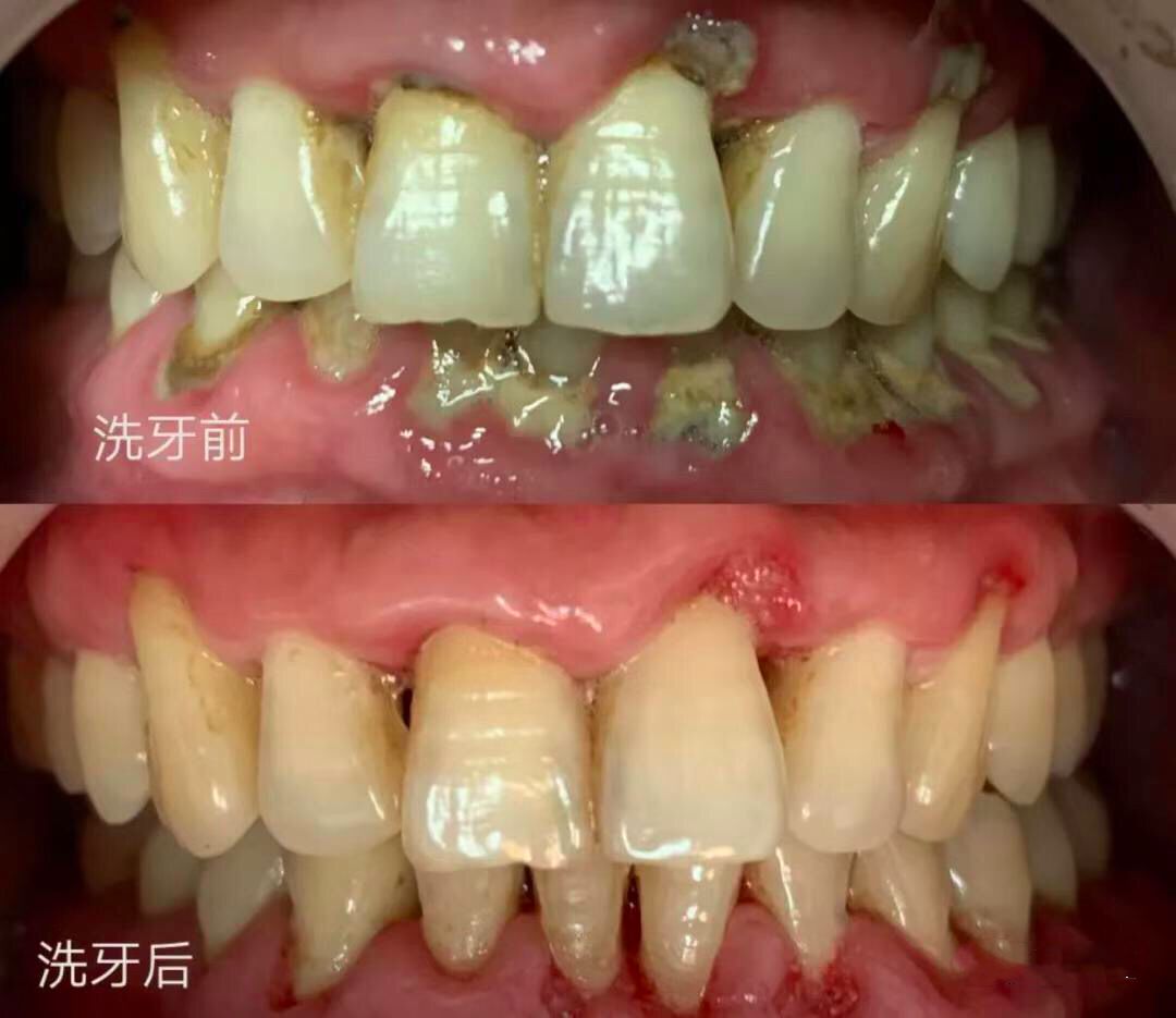 数字化导板引导下一段式固定桥修复牙槽骨严重萎缩无牙颌1例-口腔科学-医学