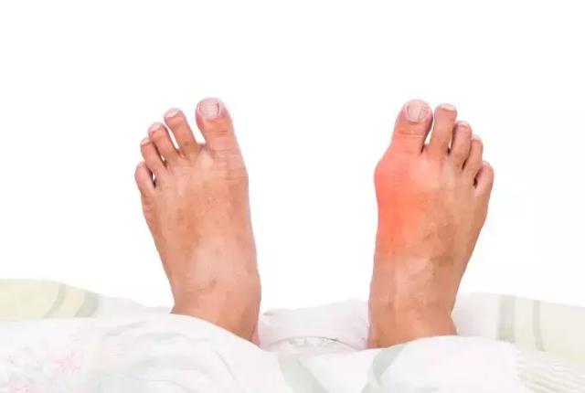 痛风石缠身?这3个“溶石”的药方值得一看!
