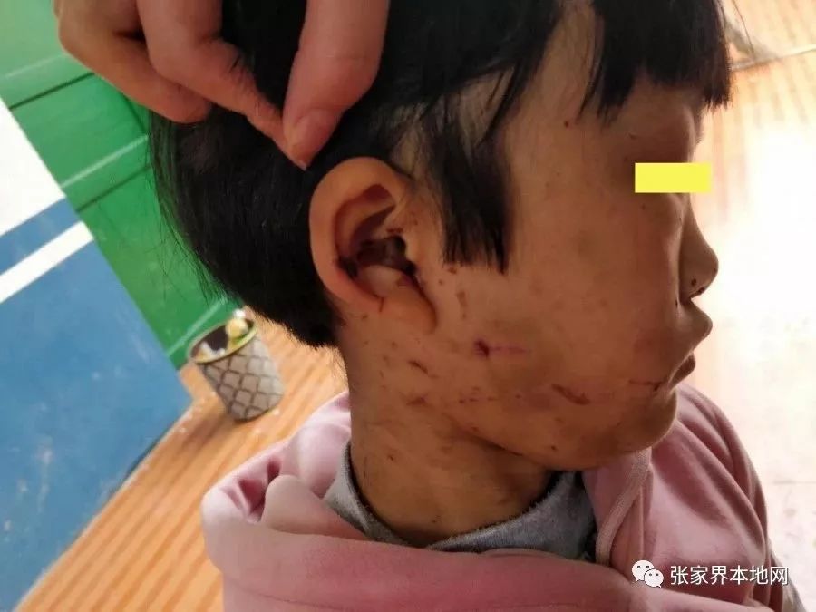 心太狠了!9岁女童遭奶奶暴打,全身多处淤青,头发被揪掉.