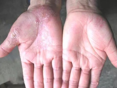 水疱型手足藓由 真菌感染造成,临床上多见于患者先有足癣,之后再传播