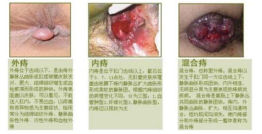 痔疮和息肉区别是什么?图片长的啥样子呢?
