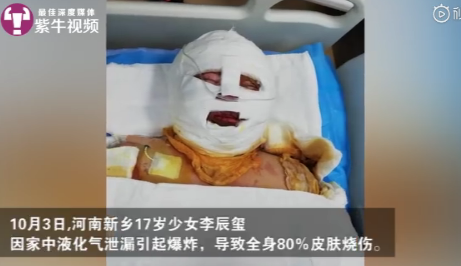 17岁女生重度烧伤,父亲瞒着给她植皮,却谎称"爸爸在工作"__凤凰网