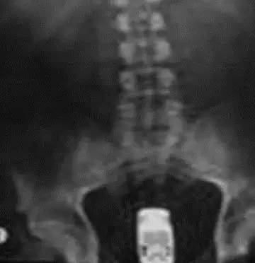8个曾经因塞异物进体内而求医的怪人，医生看到X光后当场愣住！