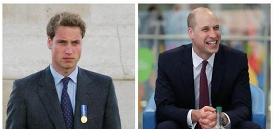英国皇室的脱发魔咒，还是没有放过哈里王子!
