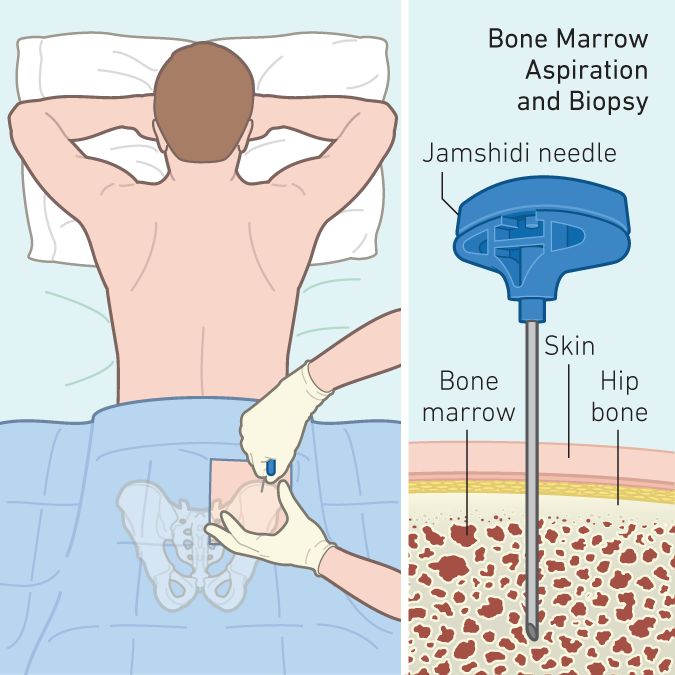 医学上还有另外一件事儿,也跟腰窝有关: 窝下方的髂后上棘,是骨髓穿刺