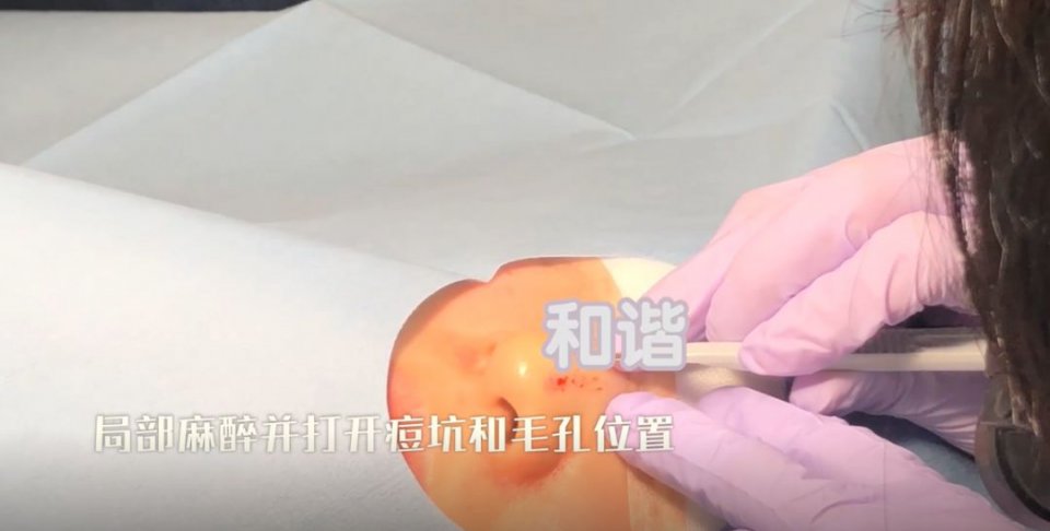 迷死氧日本亲身体验2，我用脖子上的皮给自己缝了毛孔