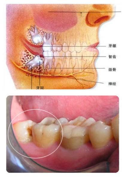 为什么会长智齿?它有什么危害?一定要拔掉吗?