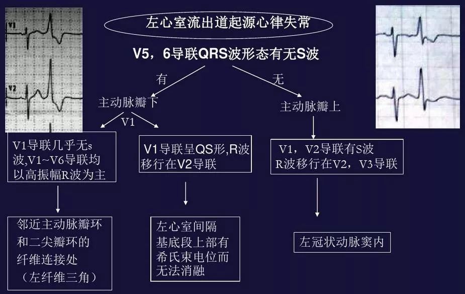 干货丨不同起源室性早搏的心电图表现及定位