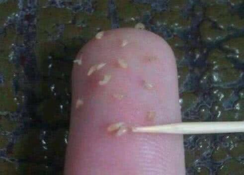 夏季，后背长出小米粒，是什么原因呢？请不要去抠它