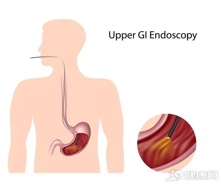 如何發現早期胃癌？胃鏡幫了大忙！選好方式很重要 健康 第8張