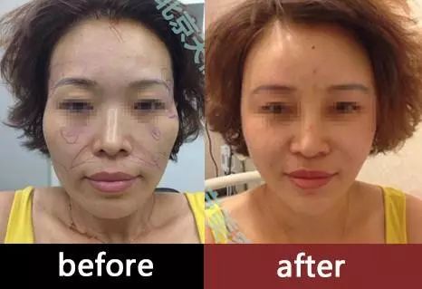 回春没多久的杨紫，咋又肿成这样了？
