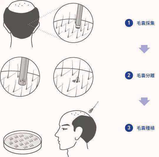 微针植发相比传统植发有啥区别吗?