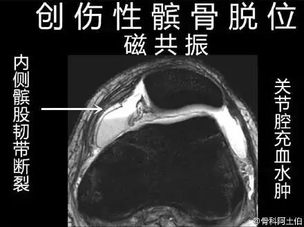 髌骨脱位了怎么办?康复练习法有哪些(图文解说)