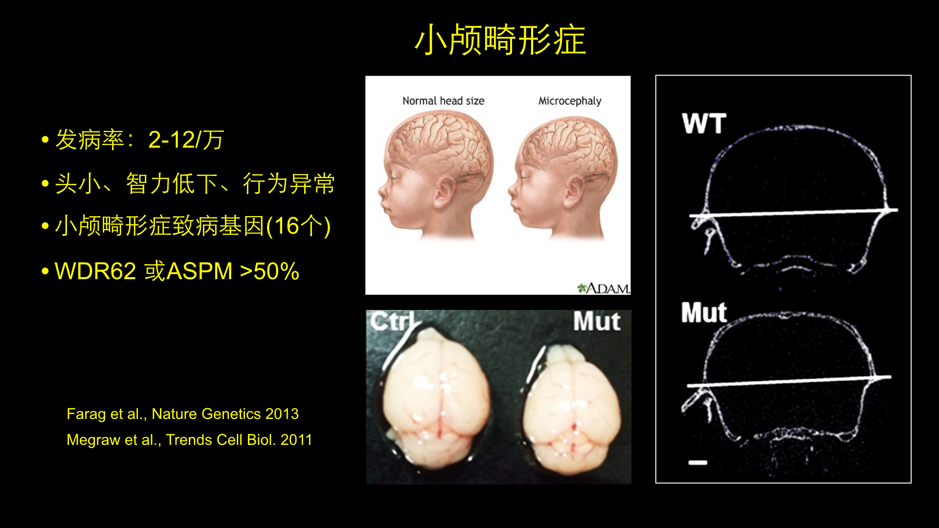 许执恒 小颅畸形症,自闭症,精神分裂症 大脑疾病背后的秘密是什么?